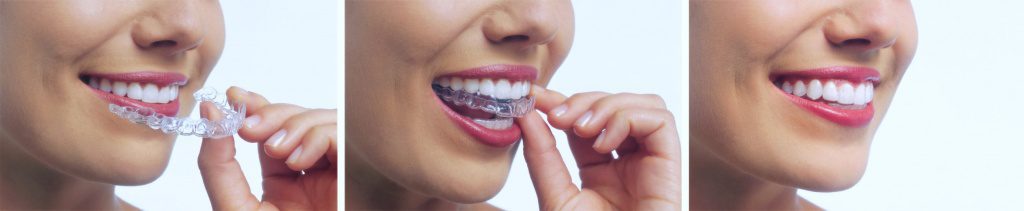 This image demonstrates that Invisalign is a Temporarily Removable teeth straightening system