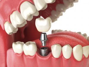 Medical Image Showing a Dental Implant Procedure
