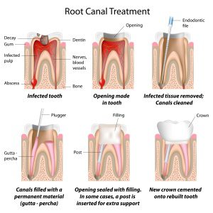 Illustration of Root Canal Therapy in Victoria, BC