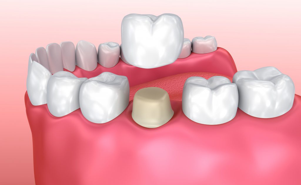 Medical Illustration of a Dental Crown