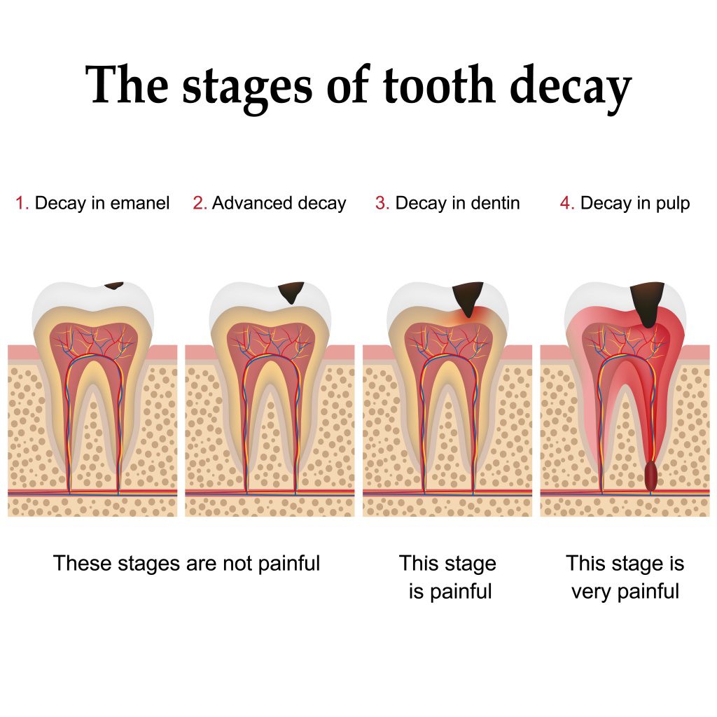 The stages of tooth decay diagram