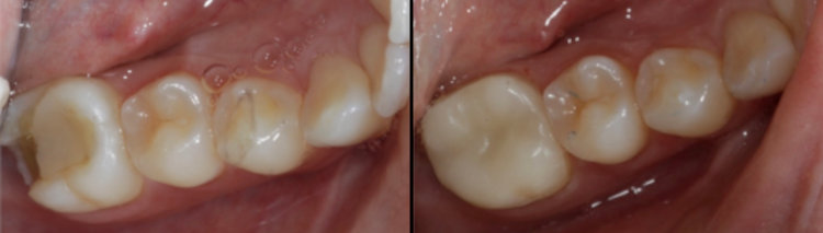 Before & After CEREC Crowns