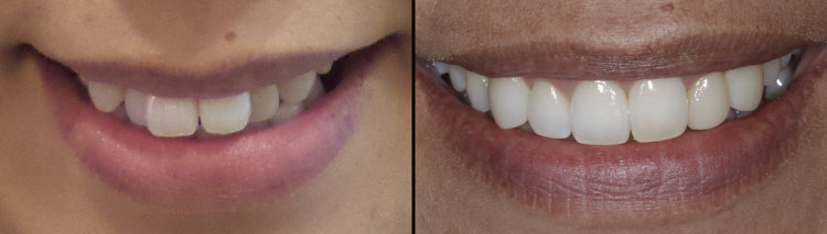 Before & After: Invisalign