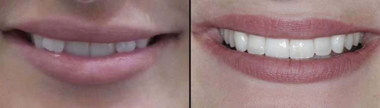 Before and After Dental Composite Buildups & Invisalign, Actual Oak Street Dental Patient