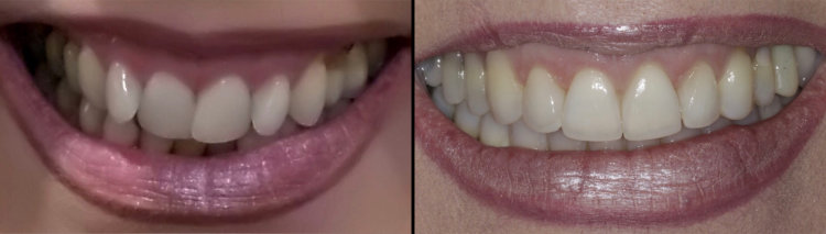 Before & After: Invisalign and Cosmetic Fillings