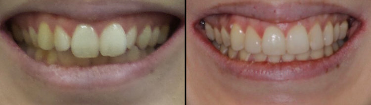 Before & After: Invisalign and Buildups