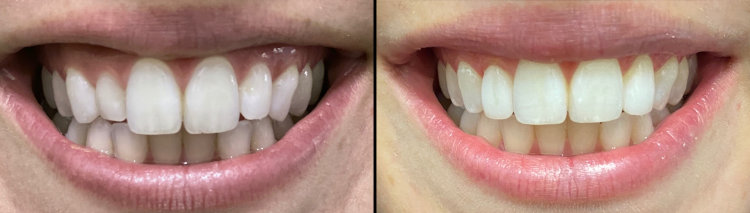 Before & After: Composite Buildups