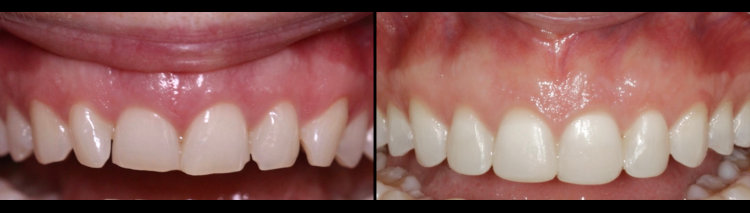 Before & After: Composite Buildups