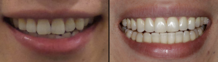 Before and After Invisalign and Cosmetic Fillings - Oak Street Dental Patients