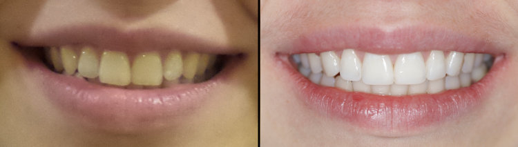 Before and After Invisalign, Cosmetic Fillings, and In-Office Teeth Whitening - Oak Street Dental Patients