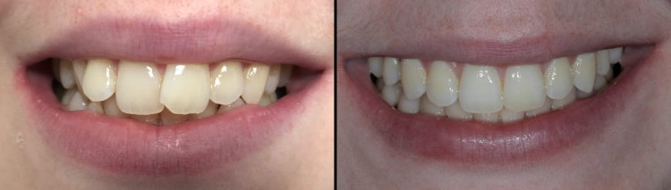 Before and After Invisalign - Oak Street Dental Patients